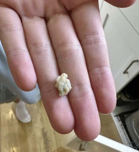 tout ce que vous devez savoir sur les calculs amygdaliens