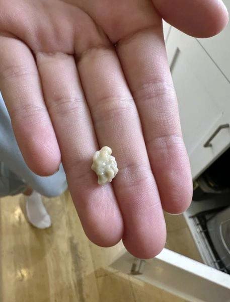 Everything you need to know about tonsil stones 25 tout ce que vous devez savoir sur les calculs amygdaliens