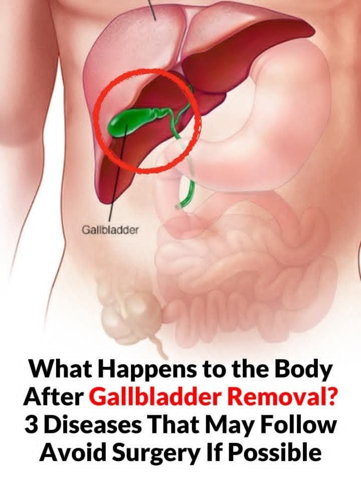 What happens to the body after gallbladder removal? 3 diseases that can follow – avoid surgery if possible 25 FB IMG 1764487021856